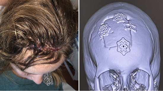 Stitches stretched across Abnet’s scalp as three metal plates and a hinge were applied to her skull. 
